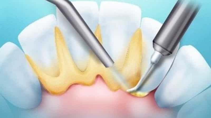 что лечит врач пародонтолог