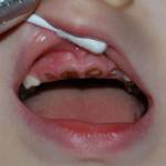 Передних зубов уже нет Передних зубов уже нет