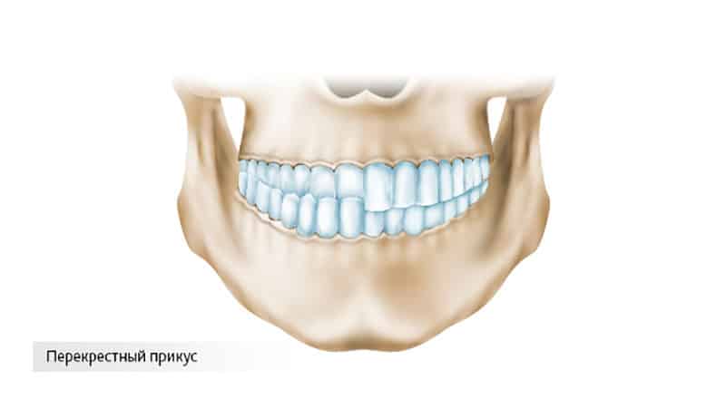 Вид перекрестного прикуса