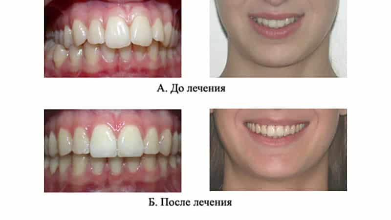 Перекрестный прикус лечение