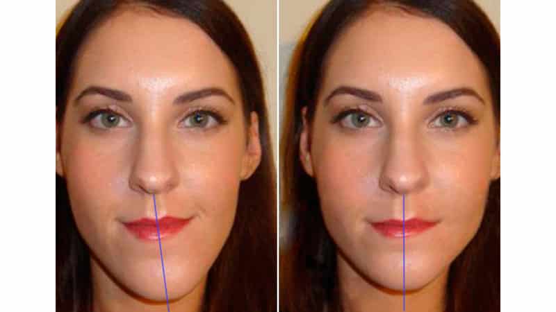 Перекос лица от перекрестного прикуса