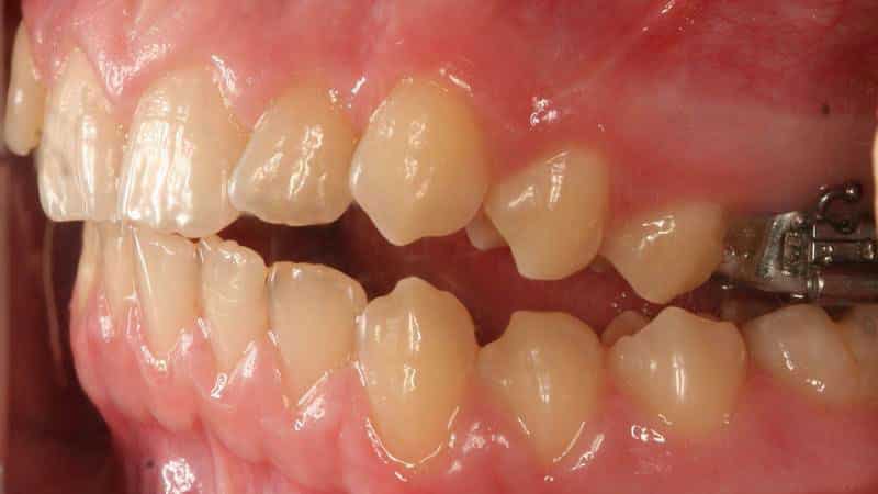 Как лечить перекрестный прикус