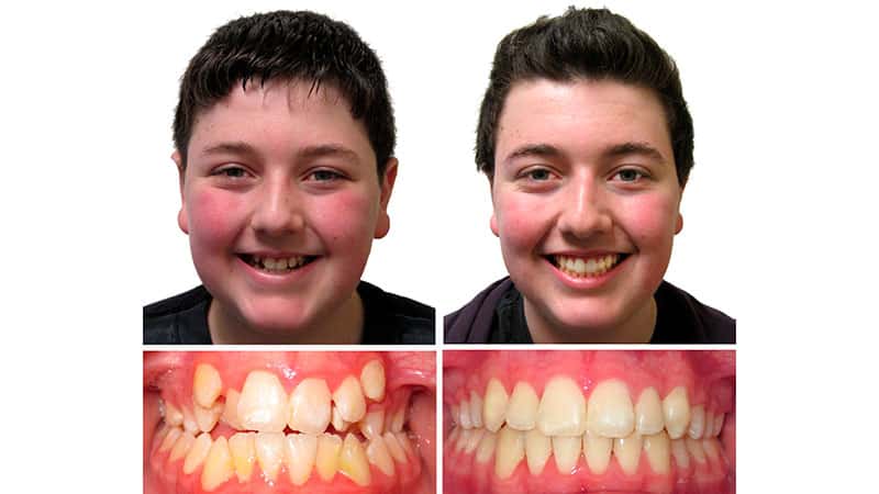 Исправление перекрестного прикуса