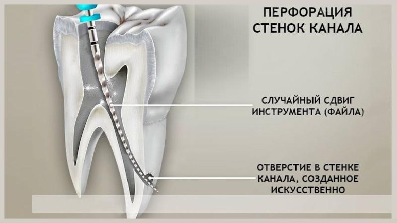 перфорация корня зуба лечение