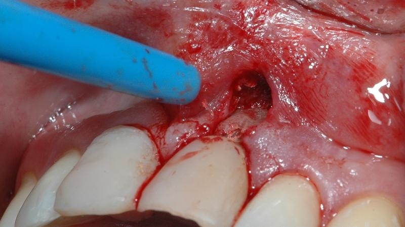 перфорация зуба что это такое