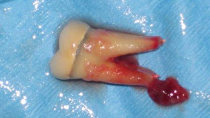 перфорация дна полости зуба фото