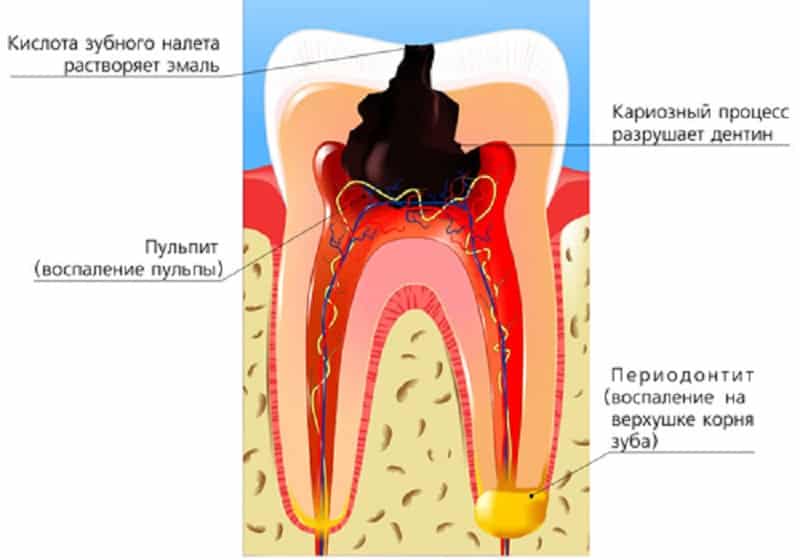 как лечить периодонтит лечение