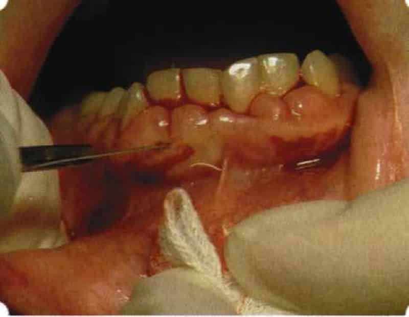 антибиотики при периодонтите