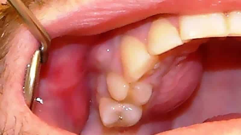 периостит верхній челюсти фото