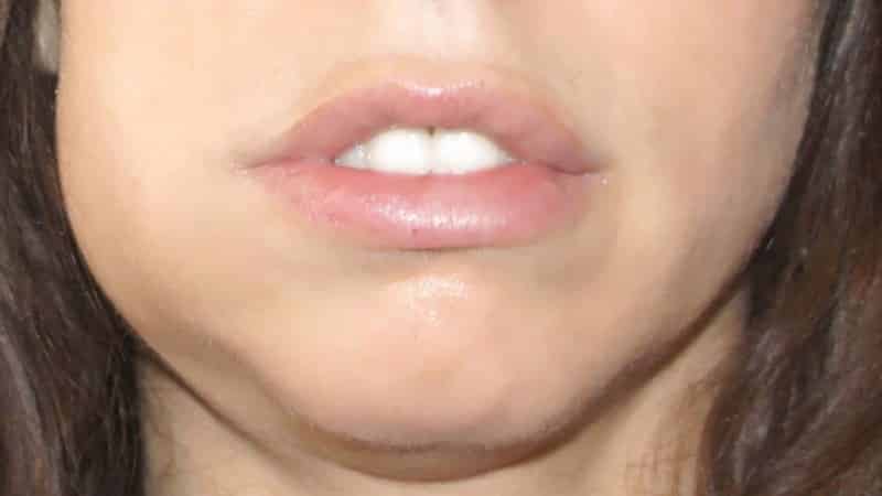 периости тнижней челюсти фото