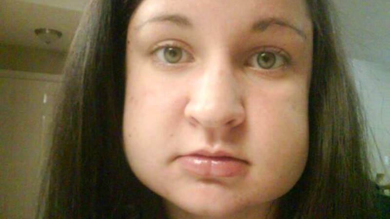 Периостит нижней (верхней) челюсти: симптомы, фото