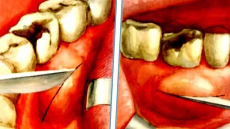 периостит челюсти фото