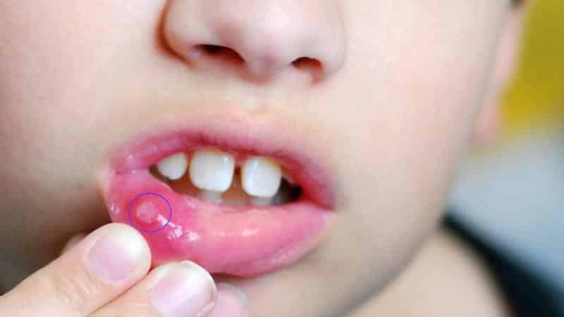 что нельзя есть при стоматите