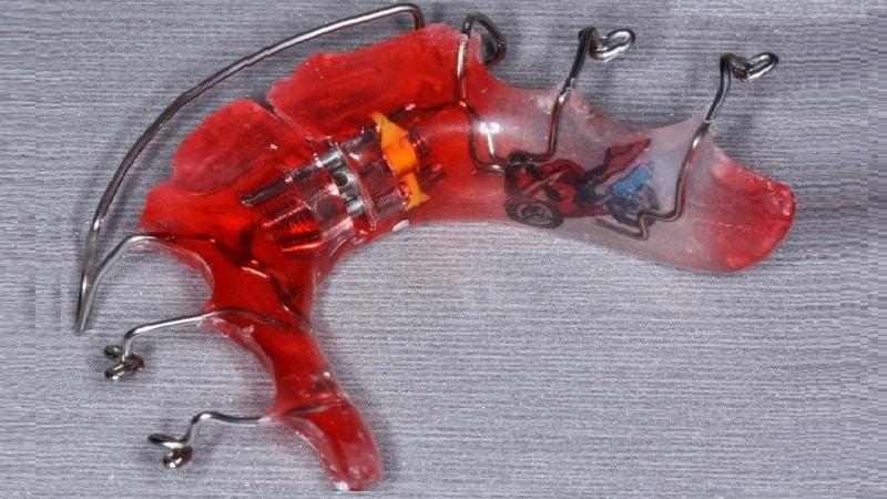 пластина для зубов детям