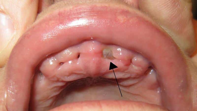 пломба со штифтом