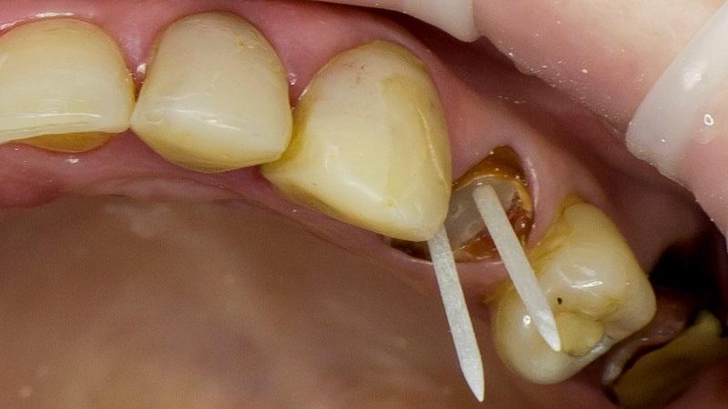 коронка на зуб со штифтом