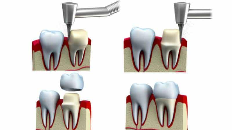 что лучше штифт или коронка