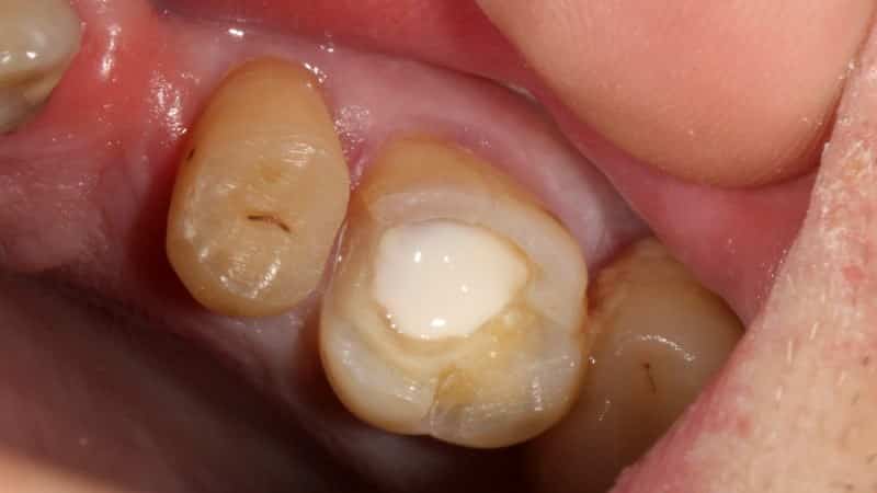 какие пломбы для зубов лучше