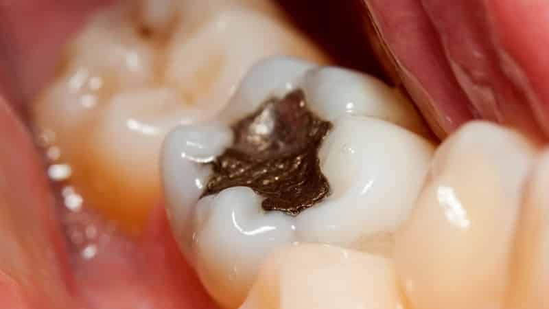 виды пломб для зубов