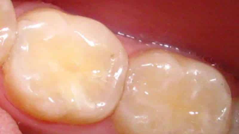 какие зубные пломбы лучше ставить