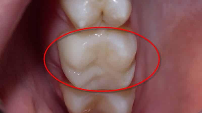 виды зубных пломб