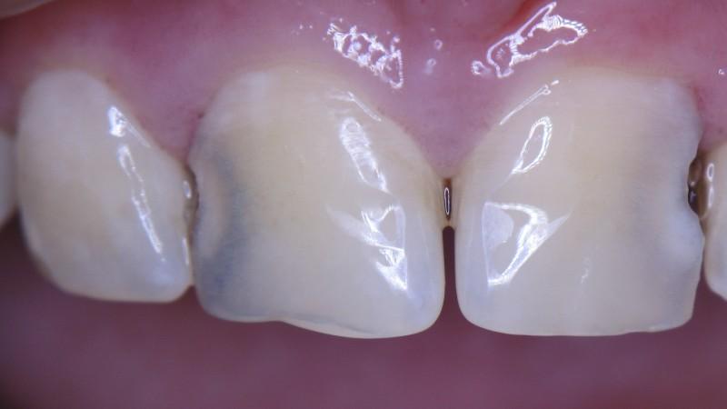 под пломбой почернел зуб