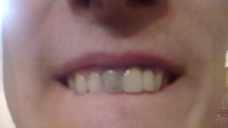 передний зуб потемнел что делать