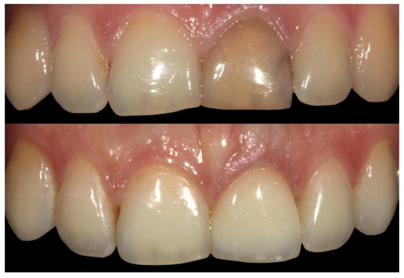 мертвый зуб потемнел и болит