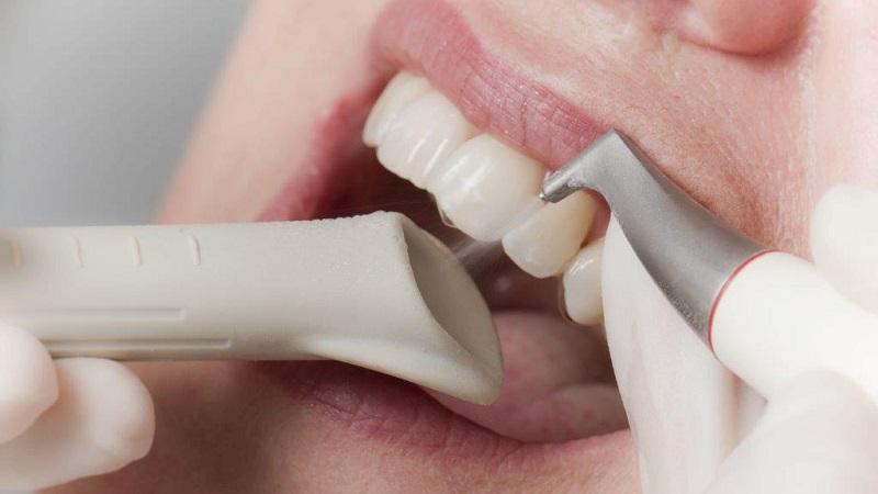 Плюсы и минусы чистки зубов методом Air Flow