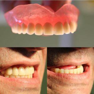 Плюсы и минусы протезов Акри Фри