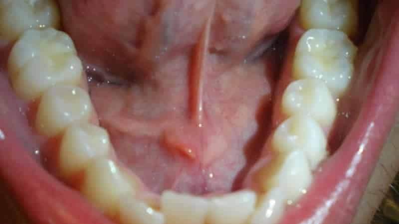 почему болит уздечка под языком