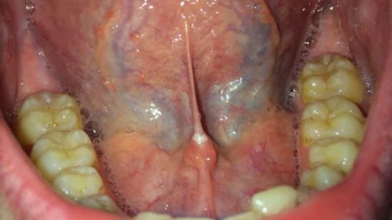 причина боли уздечки под языком