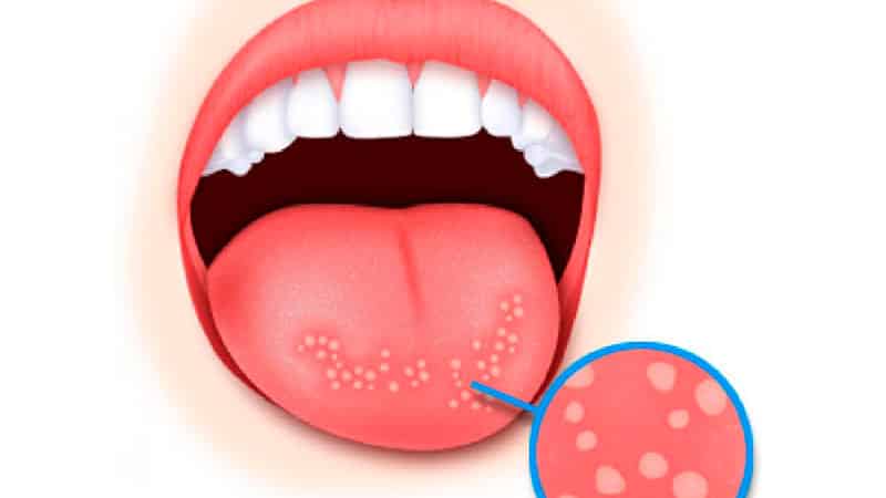 Как избавиться от боли в языке