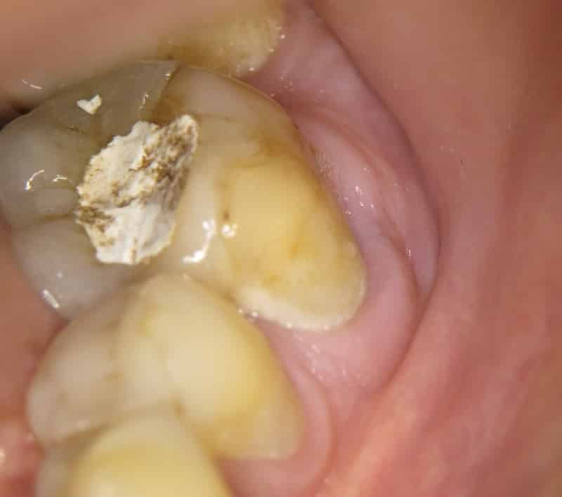почему болит зуб под временной пломбой