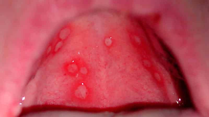 к чему чешется небо во рту