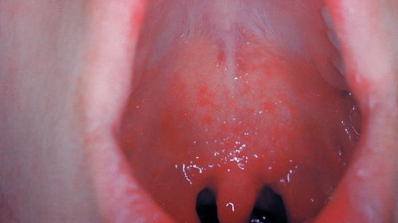 зуд неба во рту причины