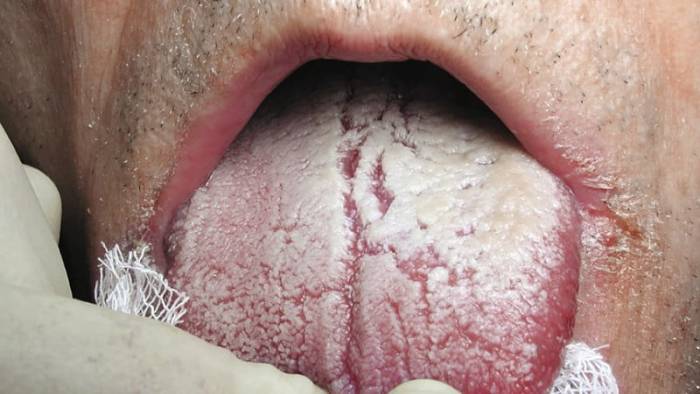 запах гнили изо рта причины