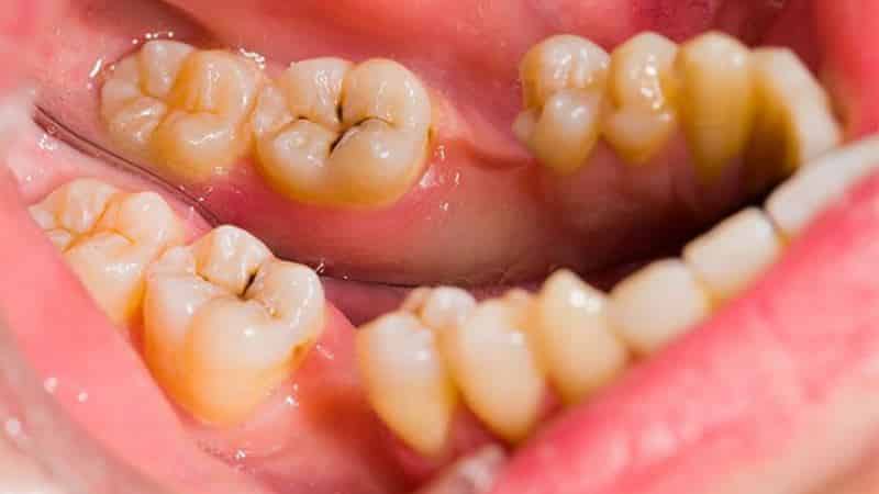 во сне сводит челюсть что делать