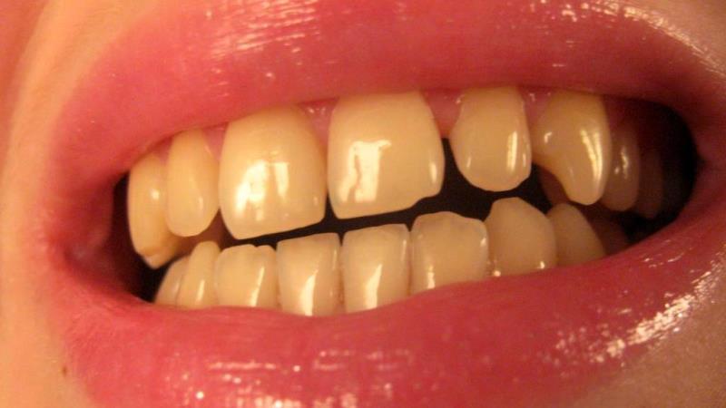 почему желтеют зубы и как их отбелить