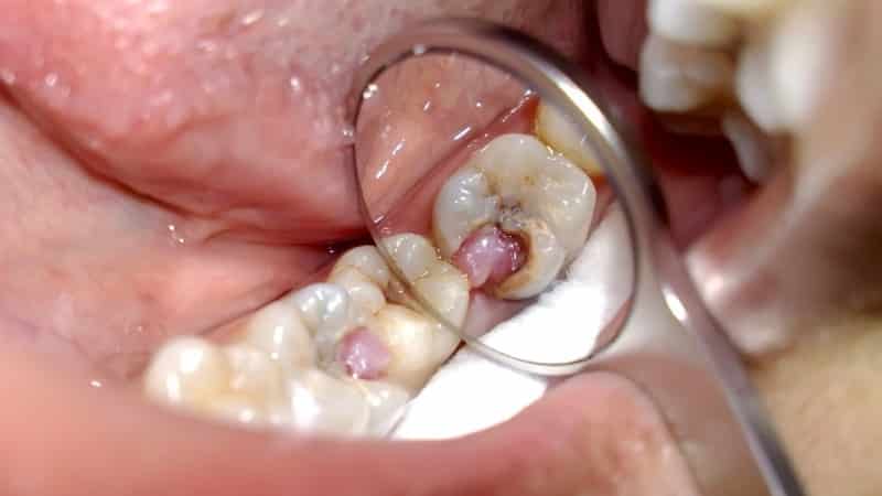 почему зуб болит только ночью