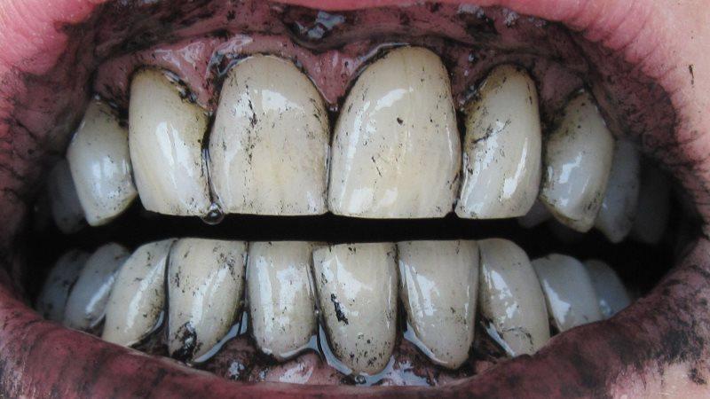 почему темнеют зубы у взрослых