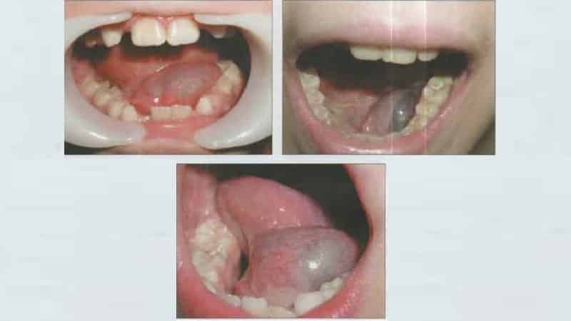 волдырь под языком что это