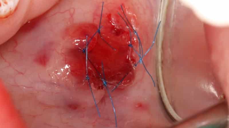 под языком появился прозрачный пузырь