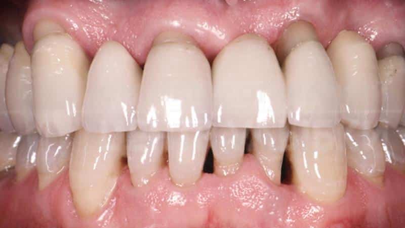 как полоскать рот перекисью водорода