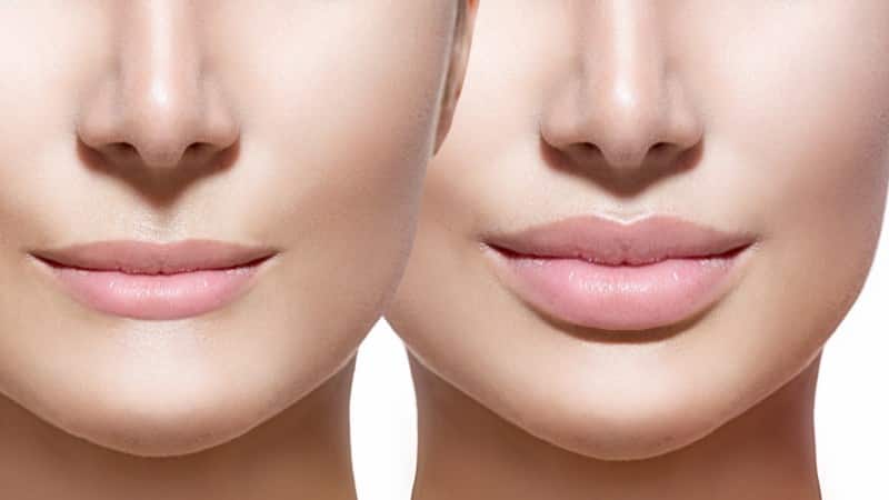 как снять отек после увеличения губ гиалуроновой кислотой