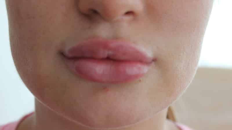 сколько держится отек после увеличения губ гиалуроновой кислотой