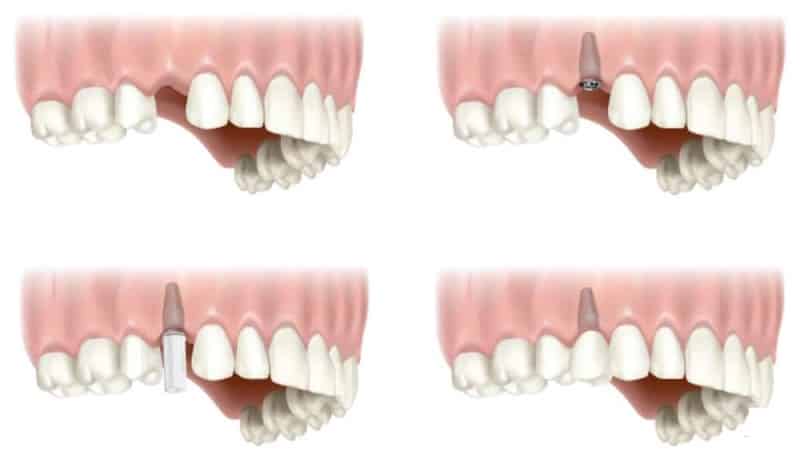 как вставить зубы если нет корня