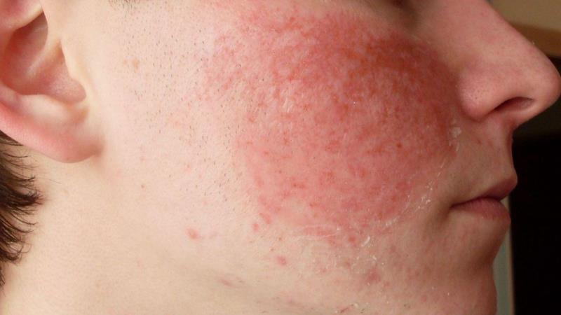 почему щеки постоянно красные