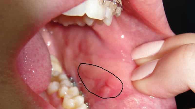 постоянно прикусываю щеку изнутри причины