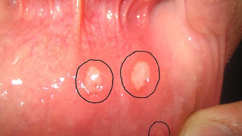 прикусила щеку изнутри чем лечить